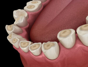 Bruxism dental attrition